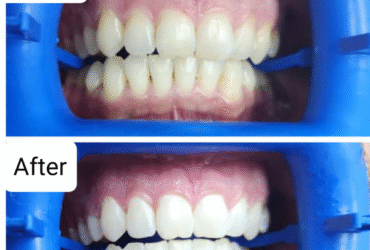 Achieve Your Perfect Smile with Expert Cosmetic Dentistry in Amman Wisdom Teeth Extraction