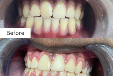 Achieve Your Perfect Smile with Expert Cosmetic Dentistry in Amman Root Canal Treatment