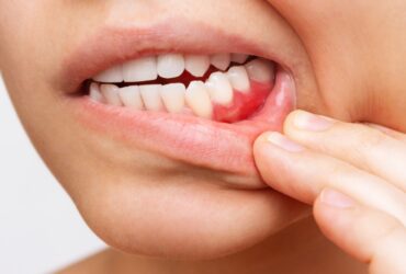 gum-inflammation-cropped-shot-young-woman-showing-red-bleeding-gums